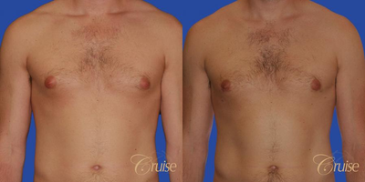 Gynecomastia Surgery before and after photo