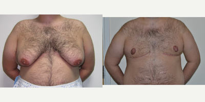Gynecomastia Surgery before and after photo