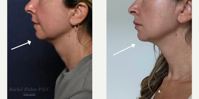 Neck Lift before and after photo