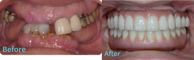 All-on-4 Dental Implants before and after photo