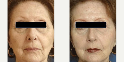 Botox before and after photo