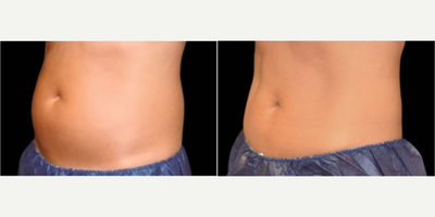 CoolSculpting before and after photo