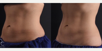 Emsculpt before and after photo