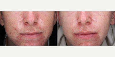 LED Light Therapy before and after photo