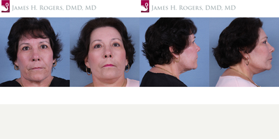 Facelift before and after photo