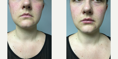 Juvederm before and after photo