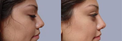 Nonsurgical Nose Job before and after photo
