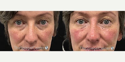 Nonsurgical Nose Job before and after photo