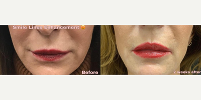 Radiesse before and after photo