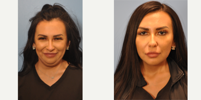 Chin Liposuction before and after photo