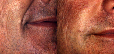 Dermal Fillers before and after photo