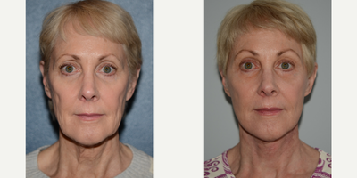 Facial Fat Transfer before and after photo