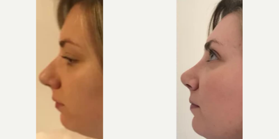 Rhinoplasty before and after photo
