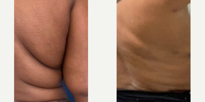 Smart Lipo before and after photo