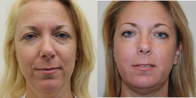 SmartSkin before and after photo