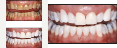 Teeth Whitening before and after photo
