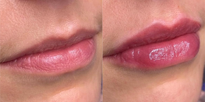 Dermal Fillers before and after photo