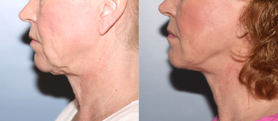 Facelift before and after photo