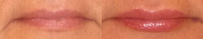Lip Fillers before and after photo