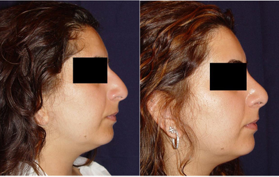 Rhinoplasty before and after photo