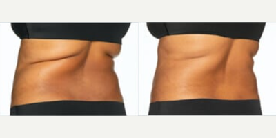 CoolSculpting before and after photo