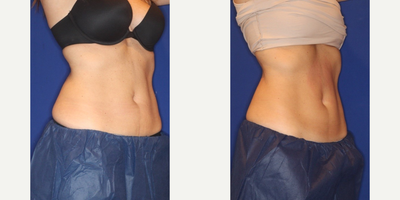 Emsculpt before and after photo