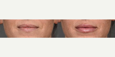 Juvederm before and after photo