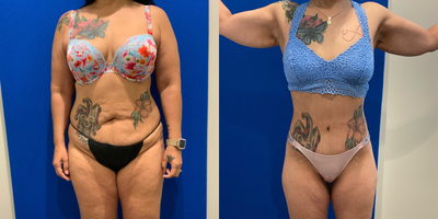Liposuction before and after photo