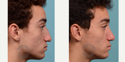 Septoplasty before and after photo
