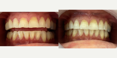 Smile Makeover before and after photo