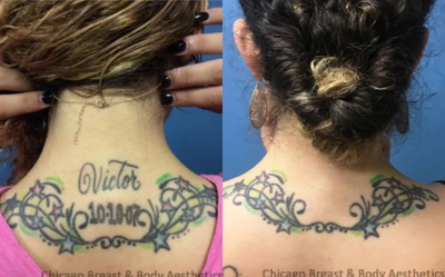 Tattoo Removal before and after photo