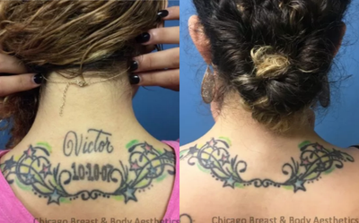Tattoo Removal before and after photo
