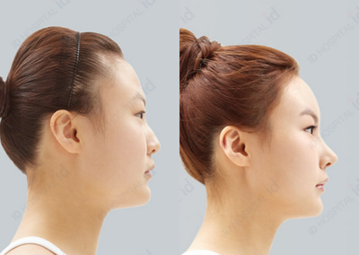 Asian Rhinoplasty before and after photo