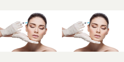 Botox before and after photo