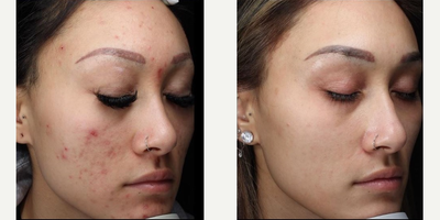 Clear and Brilliant before and after photo
