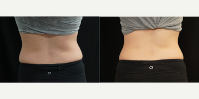 CoolSculpting before and after photo