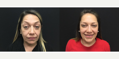 Dysport before and after photo