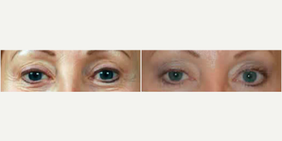 Eyelid Surgery before and after photo