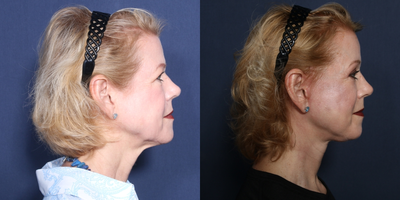 Facelift before and after photo