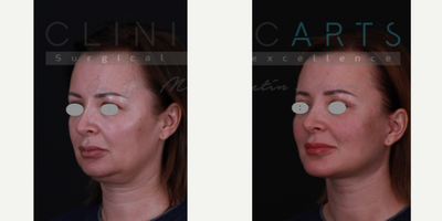 Facelift before and after photo