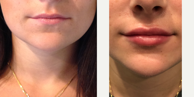Juvederm before and after photo