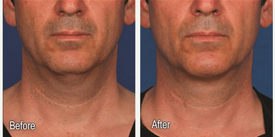 Kybella before and after photo