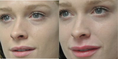 Lip Fillers before and after photo