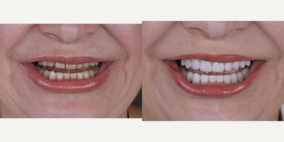 Smile Makeover before and after photo