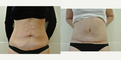 Tummy Tuck before and after photo