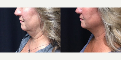 CoolSculpting before and after photo