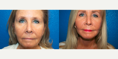 Facelift before and after photo