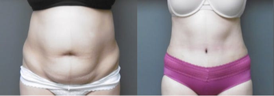 Tummy Tuck before and after photo