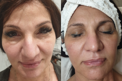Botox before and after photo