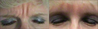 Botox before and after photo